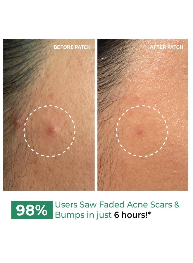 Conscious Chemist® Self Dissolving Microneedle Acne Patches (Pack of 8 Patches) | Painless & Effective Pimple Patches with 2% Salicylic Acid, Azelaic Acid & Niacinamide | Kills Bacteria, Reduces Redness, Scarring & Excess Sebum | Visible Results in 6 Hours - Image 4